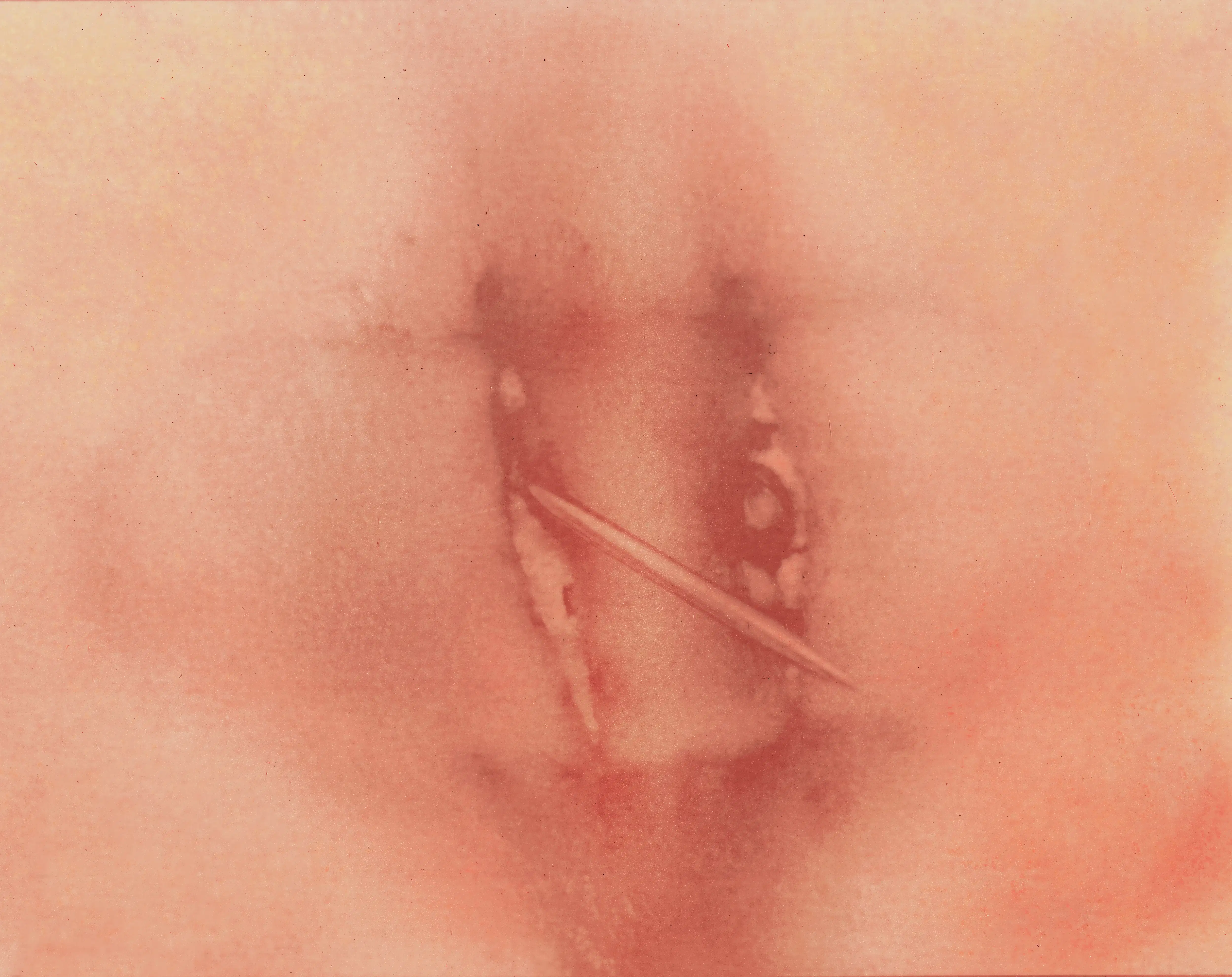 Silver needle passing through an apple slice.